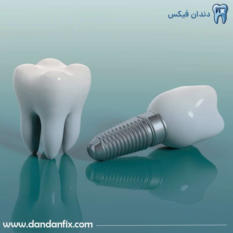 ایمپلنت فوری دندان + آیا واقعاً می‌شود در یک روز صاحب دندان شد؟